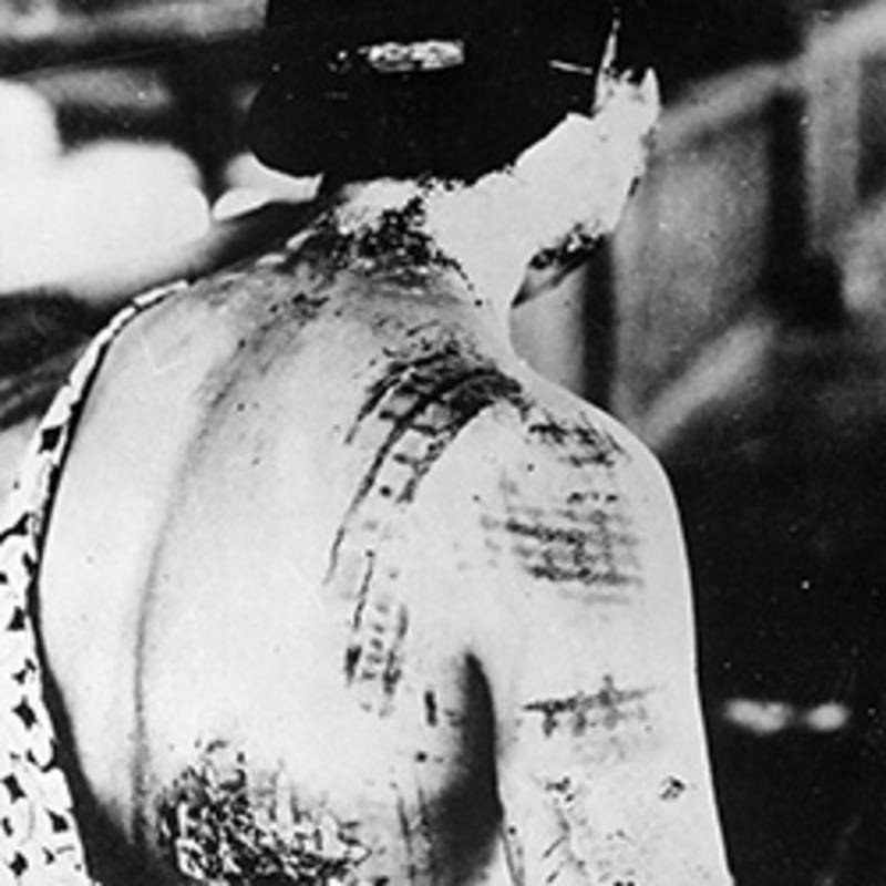 Weibliches Atombombenopfer mit schweren Verbrennungen. Das Muster des Kimonos, den sie zur Zeit der Explosion getragen hat, hat sich tief in die Haut eingebrannt,  Foto: US Nationalarchiv